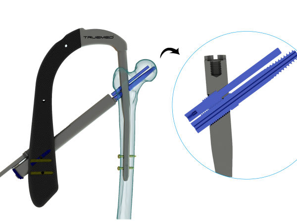 Proximal Femoral Nail