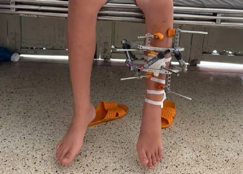 Vietnam: Hypoplasie du péroné / Chirurgie d’allongement des membres