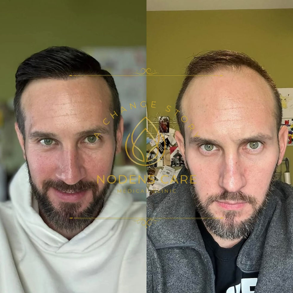 Hair Transplant in Turkey: Cost, Procedure and Results Explained