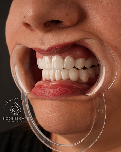 Hollywood Smile results in Istanbul Turkey featuring natural white E-max veneers.