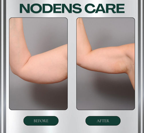 Arm lift surgery before and after - Brachioplasty skin tightening results NodensCare istanbul turkey