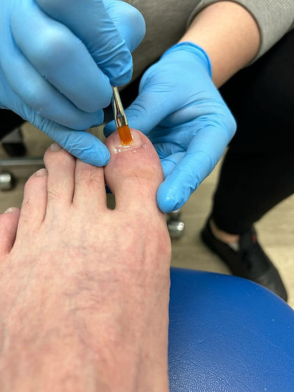 Qualified podiatrist applying topical treatment to patient toenail