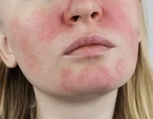 Close up of a person face showing visible redness and rosacea symptoms on the cheeks and chin