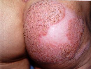 Esporotricose