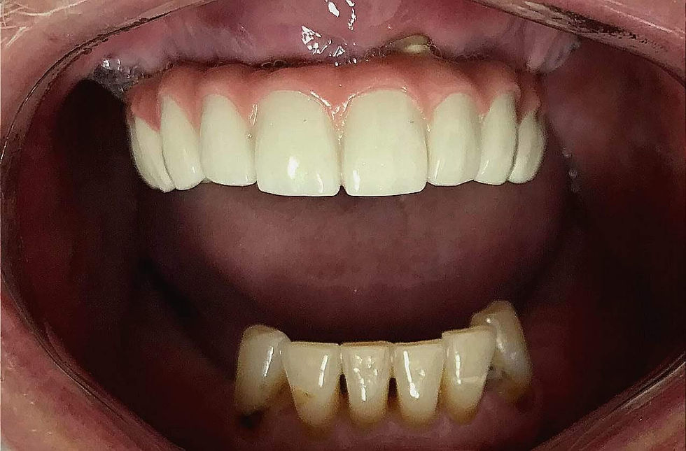 all on 4 dental implants