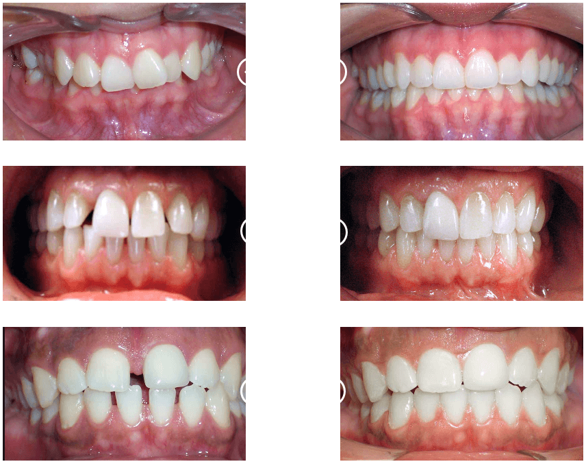 before and after dental case braces