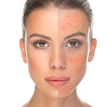 refreshing Glycolic Peel