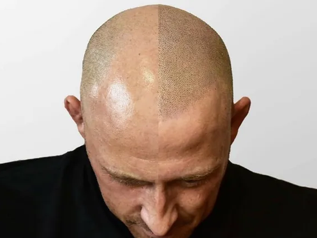 Unlock Your Potential with Our Professional Scalp Pigmentation Course
