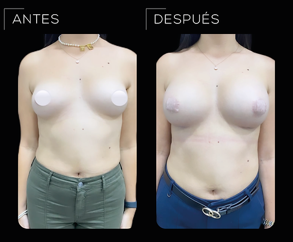 Antes&Después Aumento Mamario Brenes Leñero CirugÃa Plástica 01.png