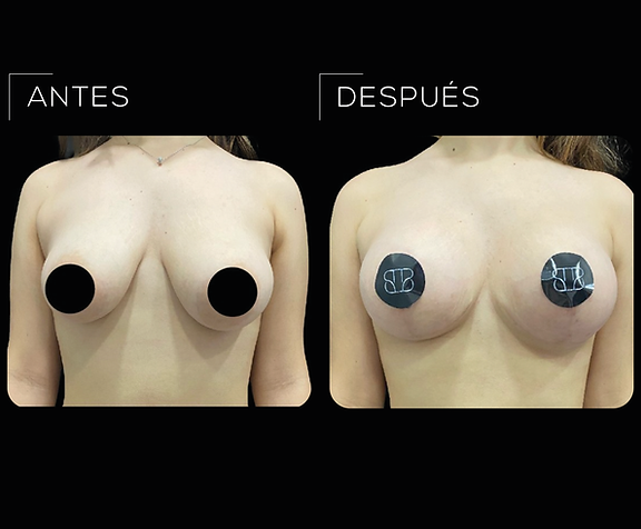 Antes&Después Mastopexia Brenes Leñero CirugÃa Plástica 01.png