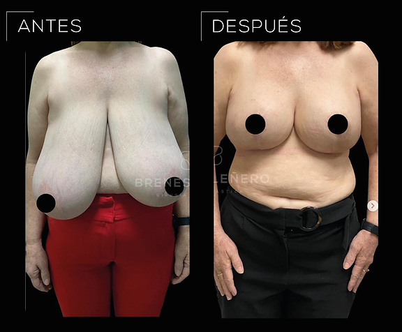 Antes&Después Reduccion mamaria Brenes Leñero CirugÃa Plástica.png