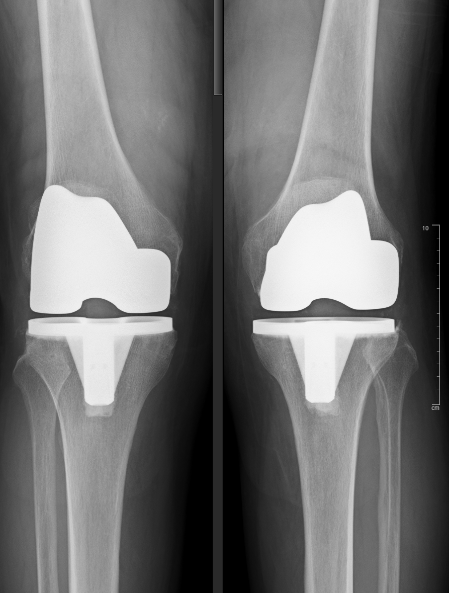 雙側人工膝關節手術