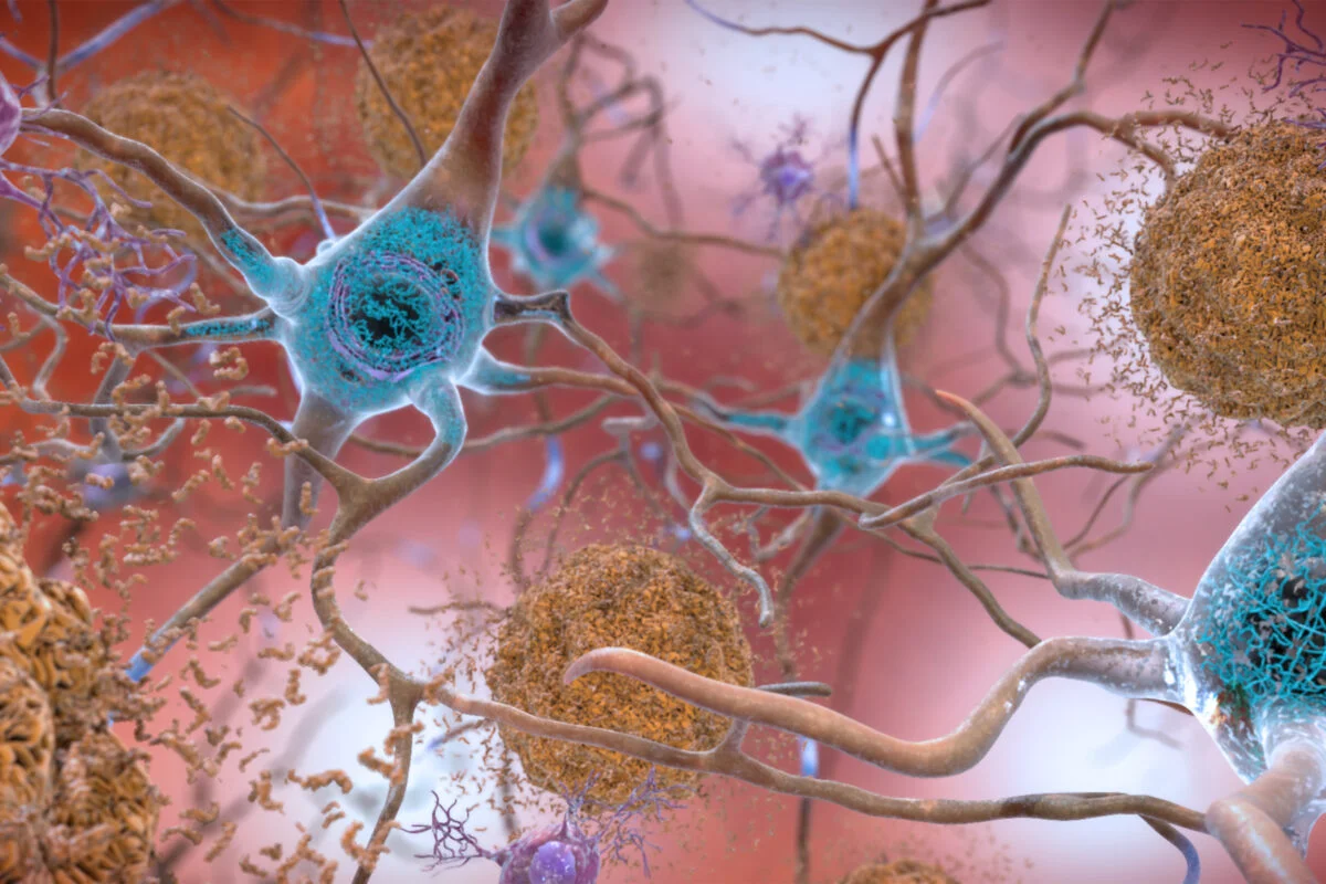 alzheimers, beta amyloid, amyloid beta, tau, alzheimers protein, how to prevent alzheimers, what is alzheimers, how does alzheimers work, alzheimers in the brain, alzheimers brain
