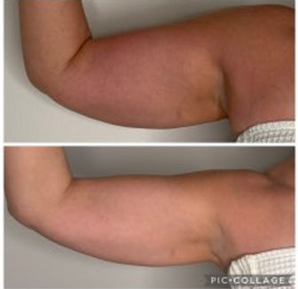 Onda Pro before & after results at Local Wellness PV arms
