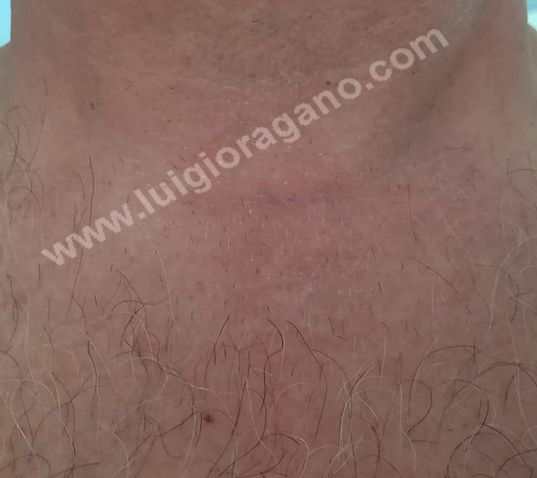 Cicatrice chirurgica - Tecnica Mini-Invasiva - Dott. Oragano
