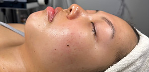 Honolulu-Oahu-Hawaii-Acne-Treatment-Specialists-The-Glow-Spot-4.JPG