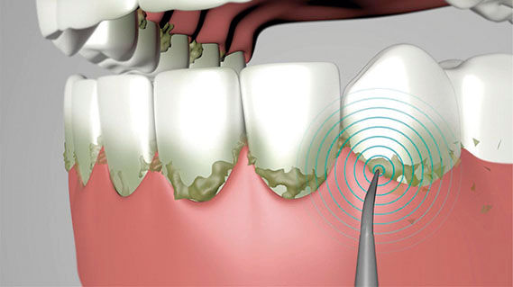 Thumbnail: VELFORM ULTRASONIC