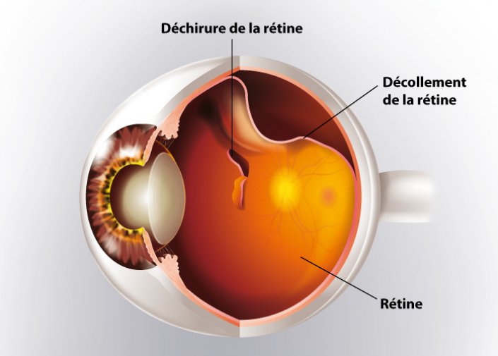 Pathologies | Décollement de rétine | Dr Leroy
