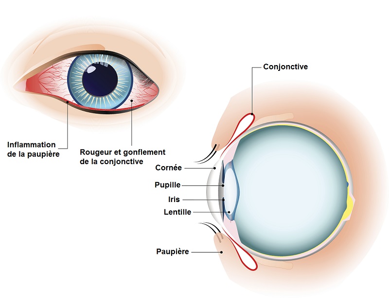 Pathologies Conjonctivite Dr Facon — free download