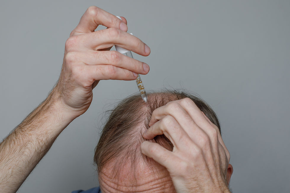 Man applying hair growth serum with a dropper on a bald spot; grey background, focus on hands and scalp, indicating hair care routine.
