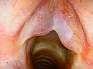 Edema di Reinke: caratteristiche, sintomi e diagnosi