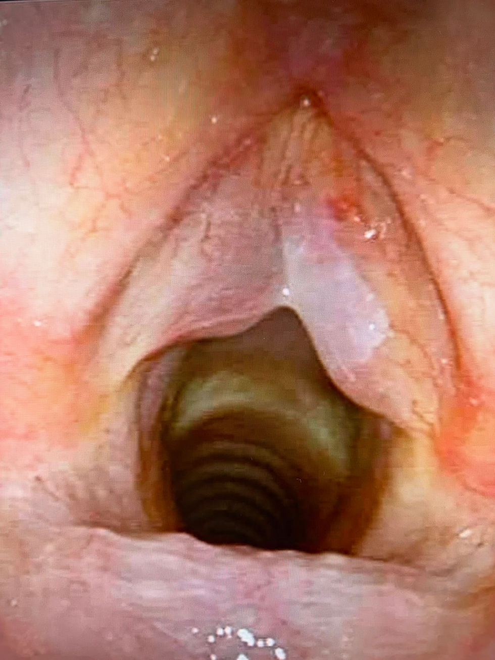 Edema di Reinke