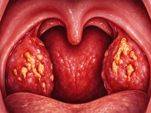 Tonsillectomia: basi anatomo-fisiopatologiche, tecnica chirurgica avanzata e gestione estesa del decorso post-operatorio