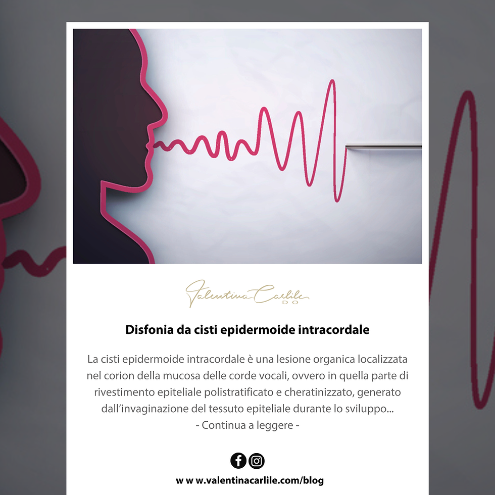 Disfonia da cisti epidermoide intracordale