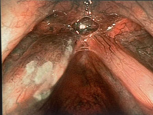 Videolaringoscopia HD e NBI: la nuova frontiera nella diagnosi dei tumori della laringe