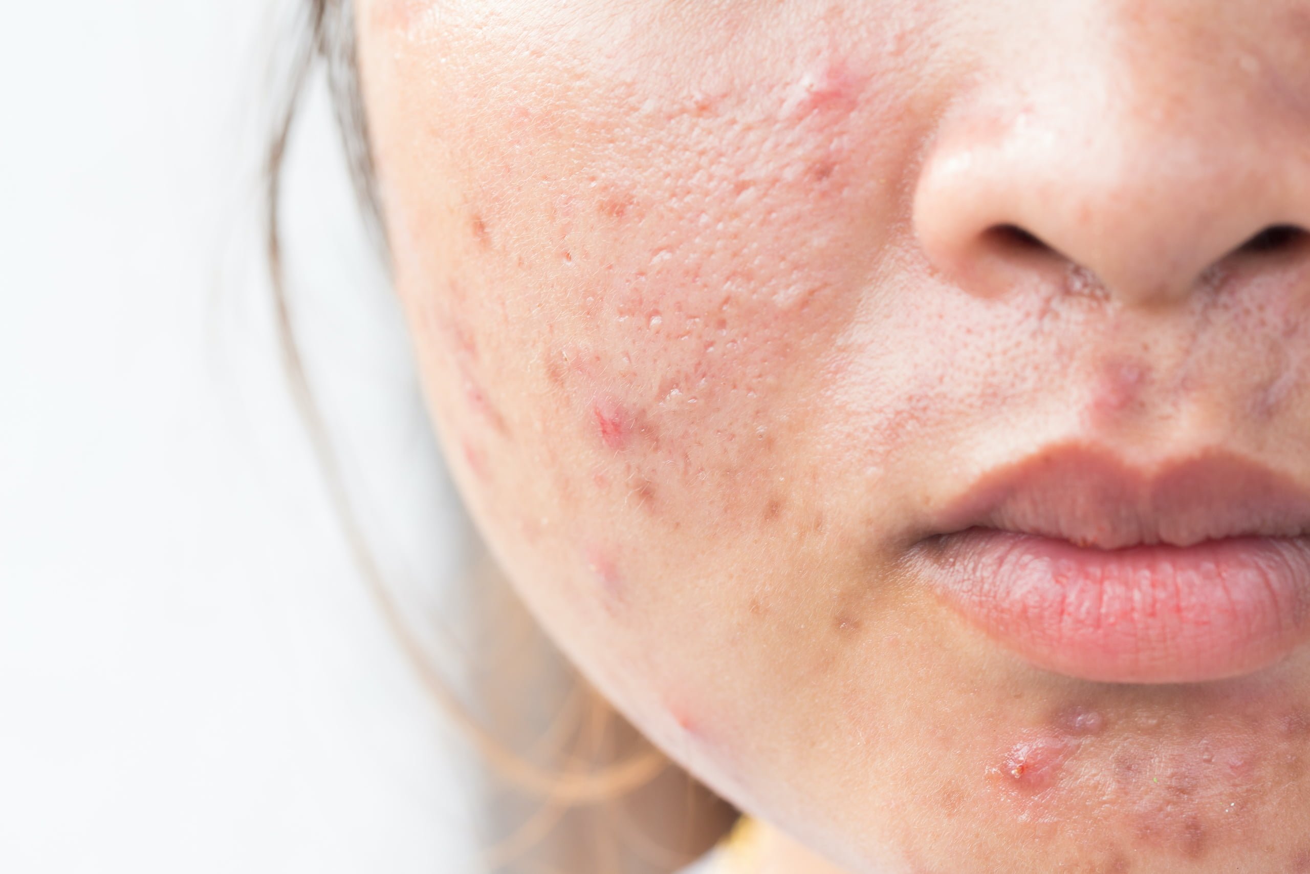 Acne Treatment.jpeg