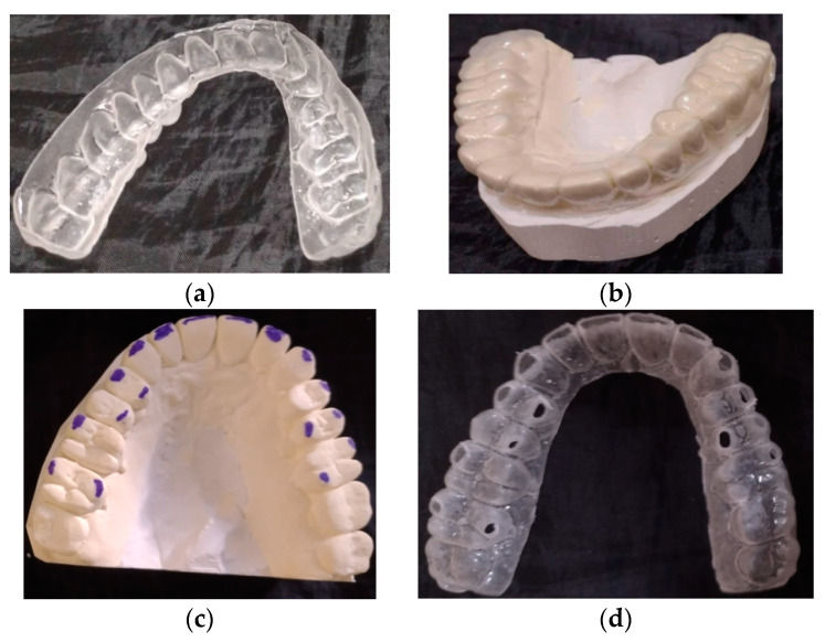Figure 2: (a) Occlusal splint for the treatment of bruxism; (b) Splint placed on the model; (c) Model with marking of places where the splint damage occurs; (d) Worn splint during bruxism treatment