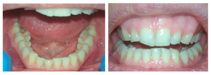 Figure 1: A patient 35 years old with bruxism. Tooth wear with attrition facets
