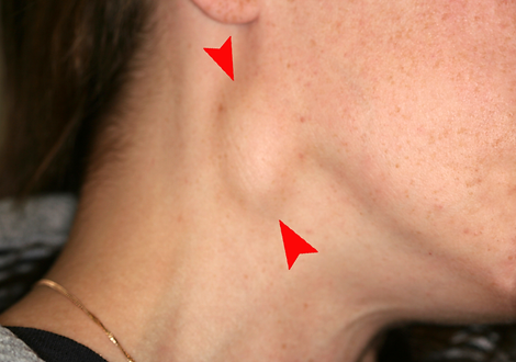 limfni čvor vrata, cervical lymph node metastasis