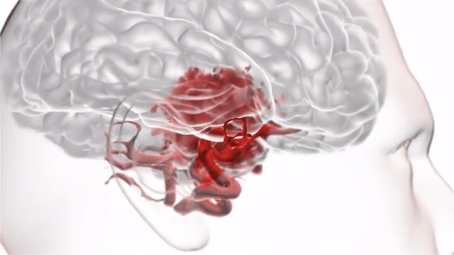 On the Origin of Cerebral Aneurysms-low