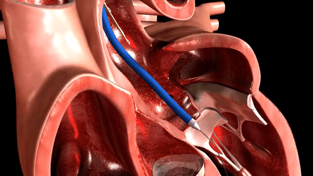 valve-medical.wmv-low