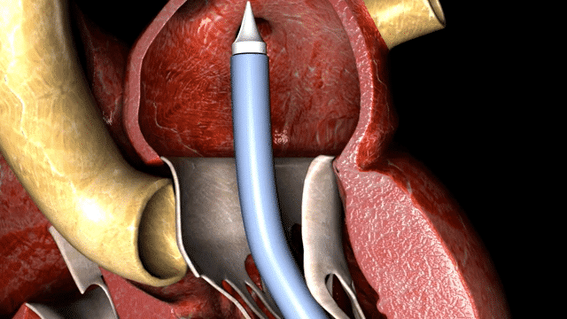 Heart device HD-low