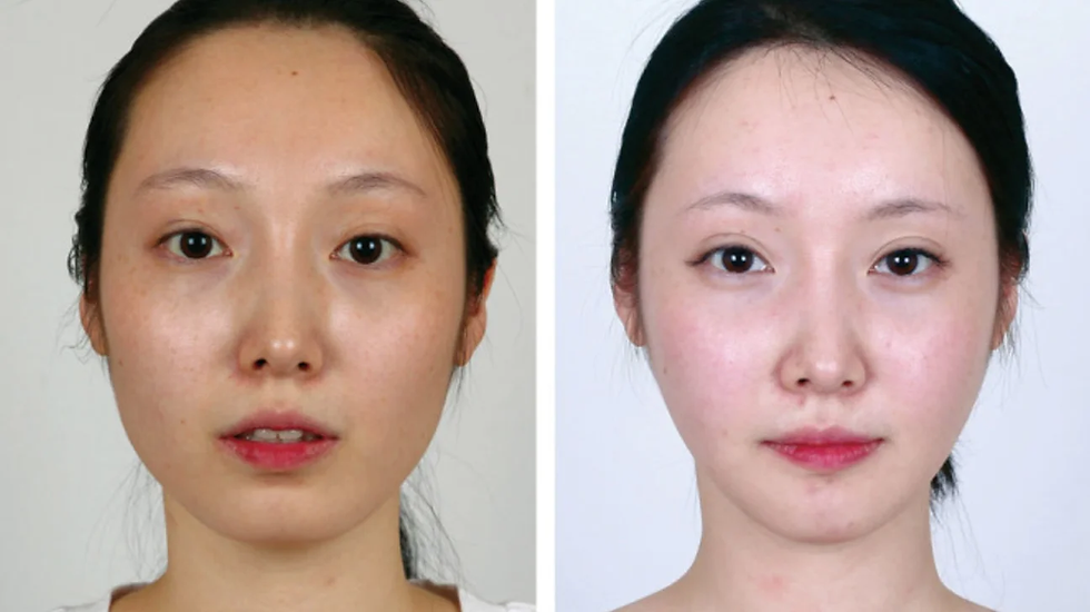 korean v-line surgery - beauty gossip girl