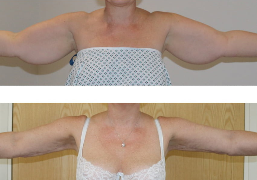 Lipedema Arm Surgery Before and After