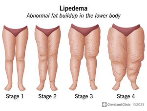 What is Lipedema? Lipedema: Symptoms, Causes, and Treatment Options
