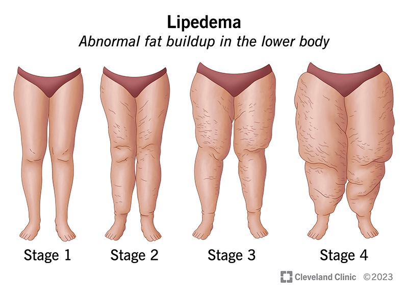 lipedema stages