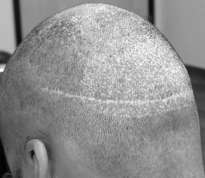 FUE and FUT hair transplant scar camouflage treatment in Surrey