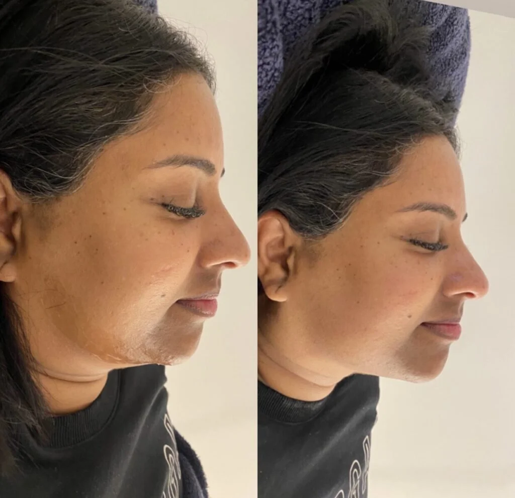 Woman take facial with after result
