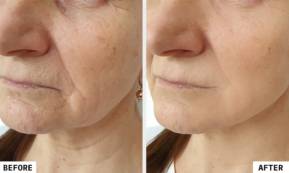 Old woman result after hifu facial