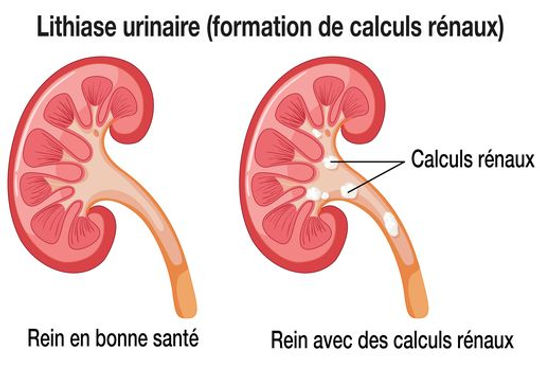 calculs-renaux.jpg