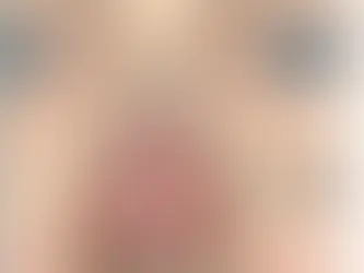 Imagem mostrando um septo desviado mostrando como o desvio de septo obstrui a passagem de ar