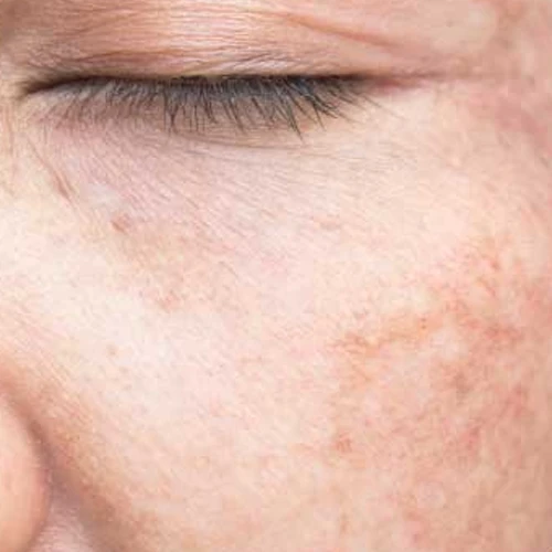 hifu-3d-dermaforce-5.webp