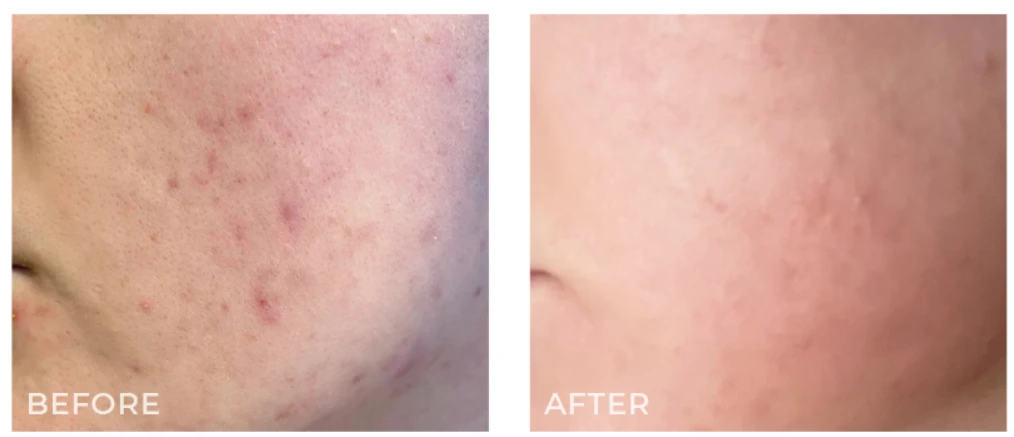 hifu-3d-dermaforce-9.webp