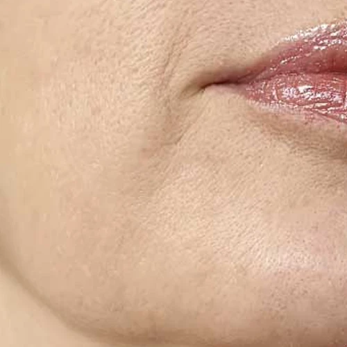 hifu-3d-dermaforce-4.webp
