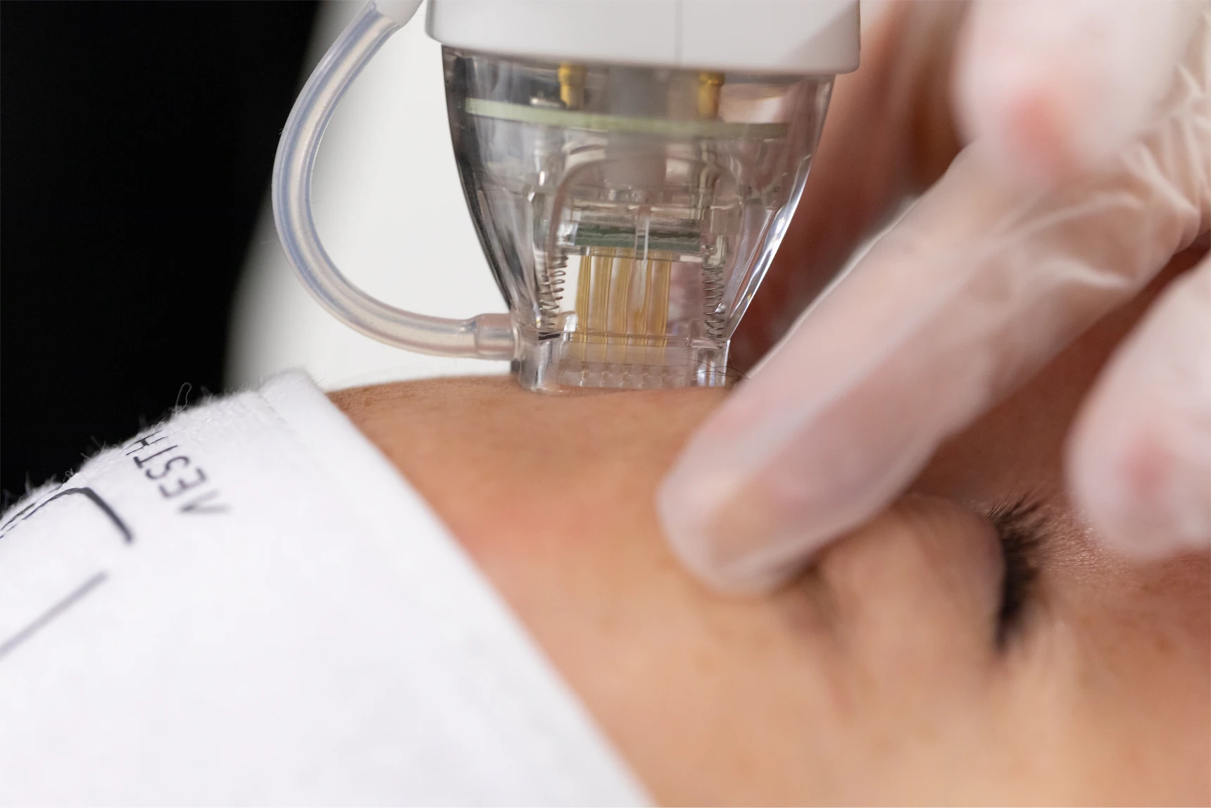 hifu-3d-dermaforce-2.webp