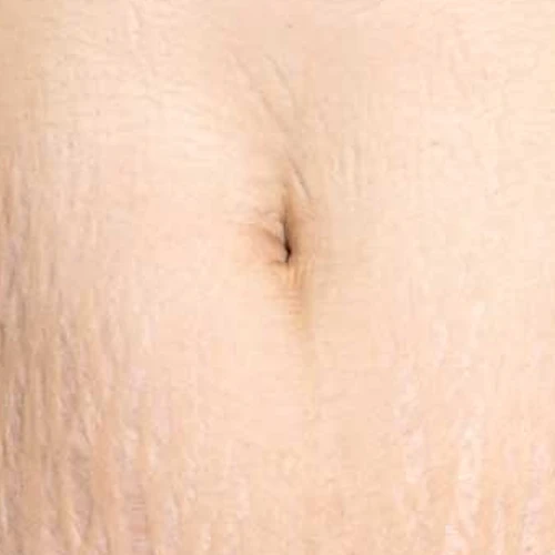 hifu-3d-dermaforce-6.webp
